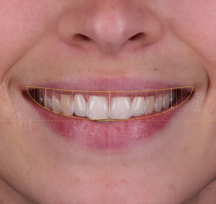 Smile Design et conception esthétique - Dr Bouganim Paris 6