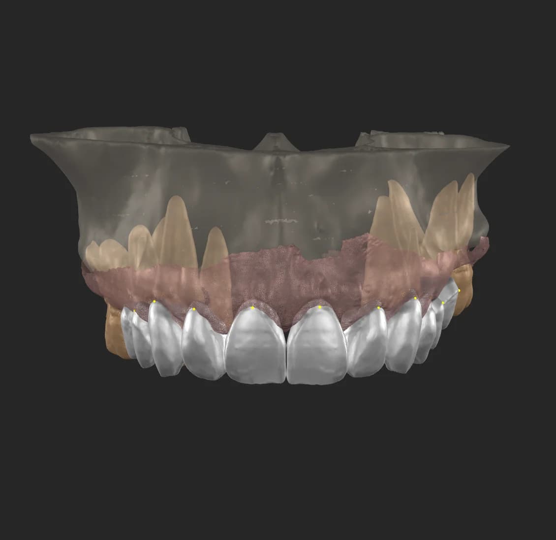 Planification digitale implantologie - Dr Bouganim Paris 6